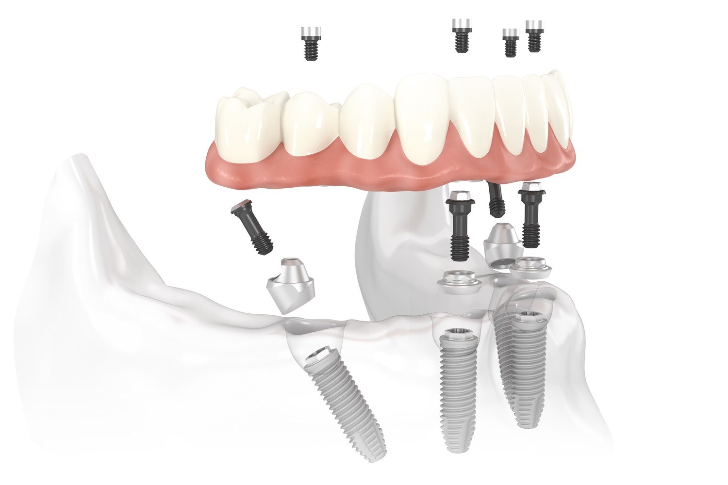 All on Four ve All on Six İmplant Uygulamaları - Özel Astro Dent Ağız ve Diş Sağlığı Kliniği, Mardin