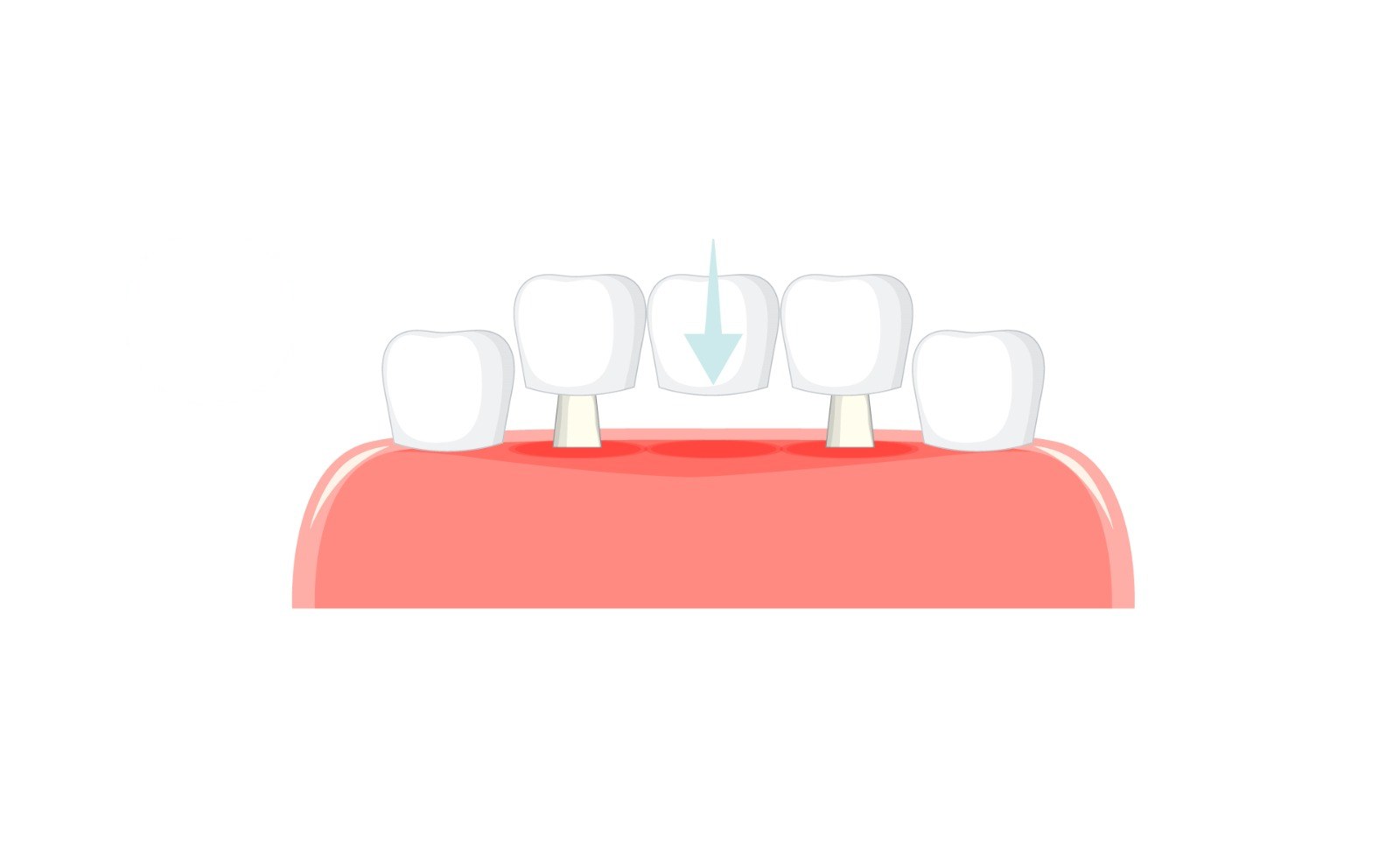 Diş Köprüsü Dental Bridge - Özel Astro Dent Ağız ve Diş Sağlığı Kliniği, Mardin